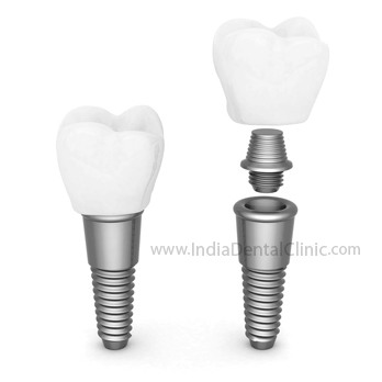 Image for Dental Offer Dental Implant Centre