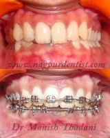 Dental Treatment image of Nagpur Dentist -orthodontic & Dental Implant Clinic