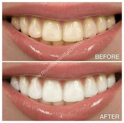 Dental Treatment image of Mumbai Dental Clinic- Cosmetic & Implant Centre